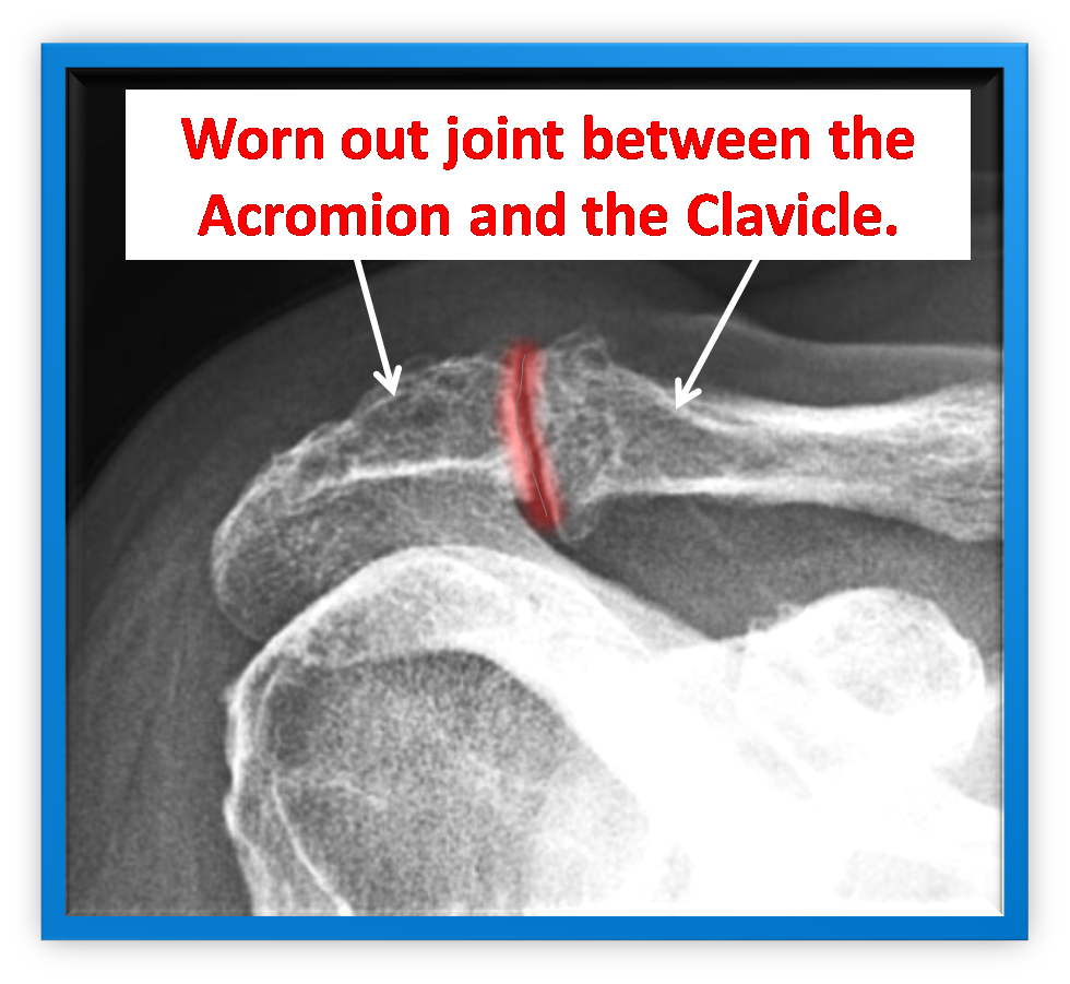 clavicularis osteoarthritis ízületi fájdalom agyalapi mirigy adenomával